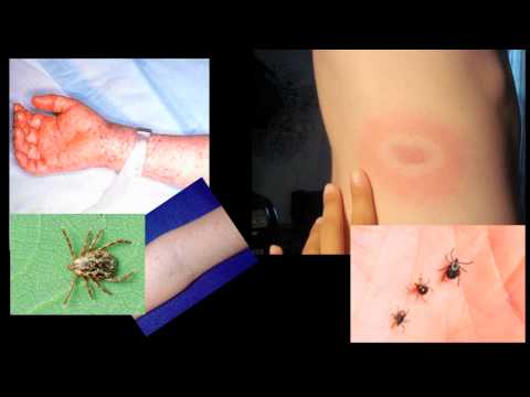 how to treat tick bites