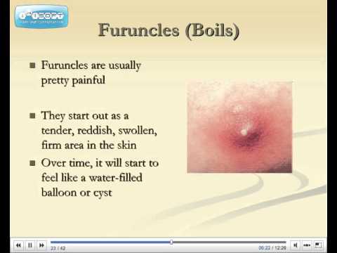how to treat folliculitis
