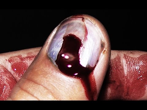 how to relieve smashed fingernail