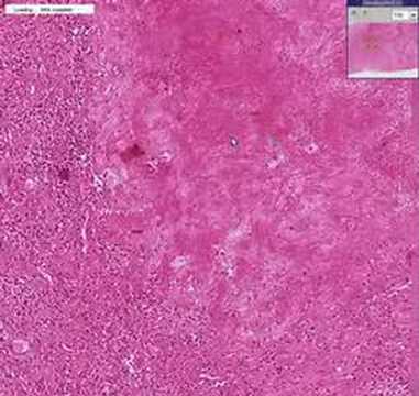 Histopathology Brain--Gumma of syphilis