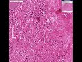 Histopathology Brain--Gumma of syphilis Histopathology Brain--Gumma of syphilis