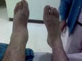 Fractura de Tobillo II