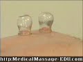 Chinese Cupping Massage