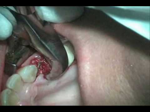 how to fix tooth decay
