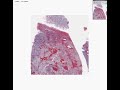 Histopathology&nbsp;Brain,&nbsp;cerebellum&nbsp;--Medulloblastoma