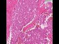 Histopathology Ovary--Granulosa cell tumor