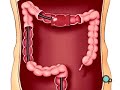 PreOp® Patient Education: Endoscopy of Large Intestine Surge Large Intestine