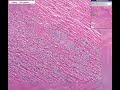 Histopathology Heart --Myocardial infarct, acute