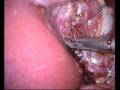 Single Port Cholecystectomy (Gallbladder removal)