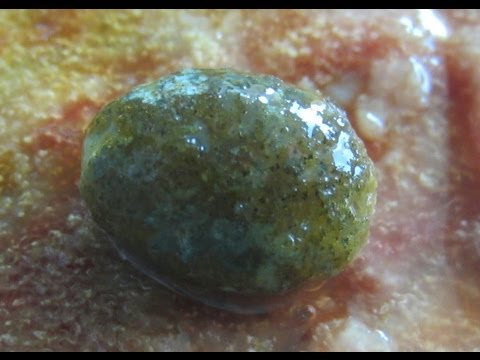 how to perform gallbladder surgery