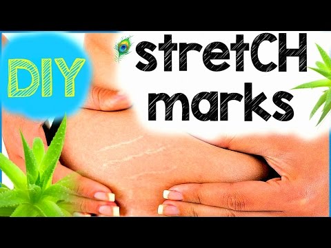 how to cure old stretch marks