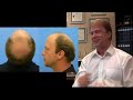 Hair Transplants - Bobman Testimonial - Hasson & Wong