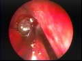 Endoscopic Removal of a Large Choanal Polyp Endoscopic Removal of a Large Choanal Polyp