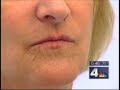 Water Bottle Causes Wrinkles NBC-4 News Coverage
