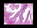Histopathology Prostate--Intraepithelial neoplasm (PIN) Histopathology Prostate--Intraepithelial neoplasm (PIN)