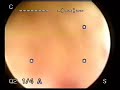 Prostate Health - TURP