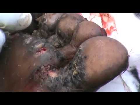 how to treat jiggers