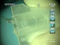 Catarata y Lente Multifocal Intraocular AcrySof ReSTOR Catarata y Lente Multifocal Intraocular AcrySof ReSTOR