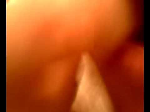 Popping abcess 1