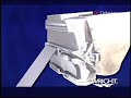 oxford-partial-knee-replacement-abroad-in-india.html