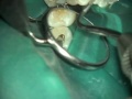 Filling complex anatomies - dr. tomas lang