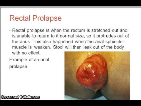 how to relieve ileus