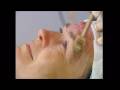 Dermaroller  treatment, Mezo-Roller kezelés, Dermaroller kezelés