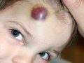 Photoshop: Large Blemish Removal (HD)