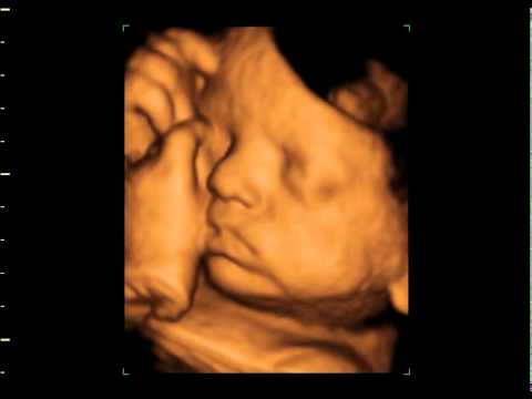 ultrasound 3d 4d - View the unbelievable clarity of this 4d Video clip of an ultrasound session taken at 36 weeks and 5 days at GoldenView Ultrasound. Watch as the baby opens a...