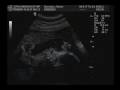Ultrasound 29 Weeks