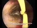 Hysteroscopic treatment of uterine synechia