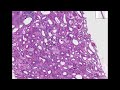Histopathology Kidney--Rapidly progressive glomerulonephriti
