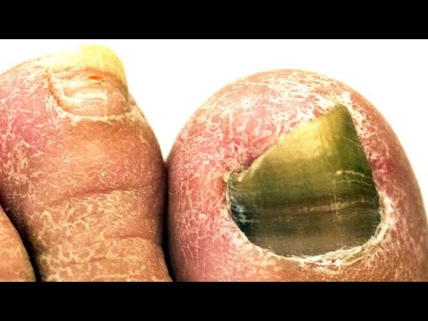 how to treat fungus between toes