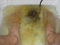 Foot Detox Day 2 Foot Detox Day 2