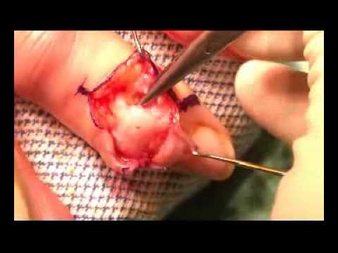 how to eliminate osteophytes