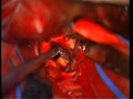 Basilar Tip Aneurysms: Contemporary Series of 100 Patients Video 1