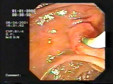 how to perform ercp