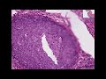 Histopathology Cervix--Squamous metaplasia & carcinoma-in-si Histopathology Cervix--Squamous metaplasia & carcinoma-in-si