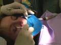 Root Canal Demonstration