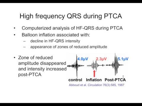 how to measure qrs amplitude