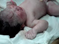nacimiento con forceps