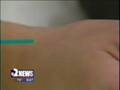 Infertility & Acupuncture