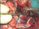 Meningioma del tercio externo del ala del esfenoides