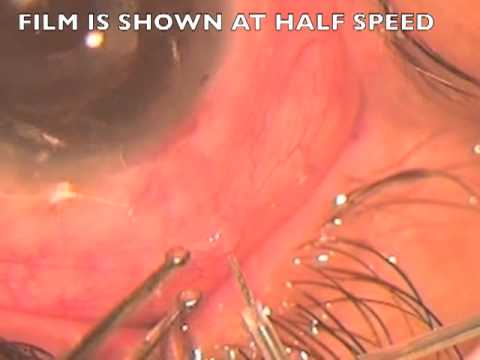 how to control glaucoma