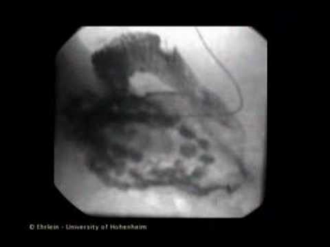 Lower GI Movies - Peristalsis