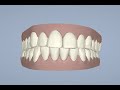 Jeanine B Invisalign Animation.avi
