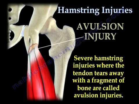 how to recover pulled hamstring