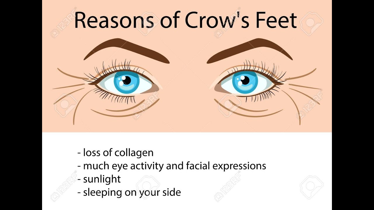 הקמטים מסביב לעיניים - איך נתקן אותם?