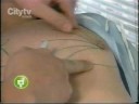 Todos los procedimientos de cirugia plastica.  Bogota Colombia, por cirujanos plásticos certificados, miembros sociedad colombiana de cirugia plastica. Centro Colombiano de  Cirugia Plastica, liposucción, lipectomía, mamo plastia de aumento, blefaroplastia, mentoplastia, bichectomia, implante capilar, cirugia de calvicie, microinjertos capilares,  aplicación de rellenos, toxina botulínica, glúteos, gluteoplastia, Dr. Ricardo Lancheros Pedraza. Restylane, Botox, Dysport aplicación. PRP, plasma rico en plaquetas.Plastic Surgery Colombia, liposuction, tommy tuck, rinoplasty,Láser de depilación, manchas arrugas, acne.Calle 94 A No 21-23 Bogota  Colombia.www.plasticayestetica.com