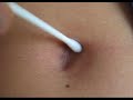 Rubbing a dry q-tip inside my navel. Rubbing a dry q-tip inside my navel.